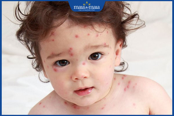 trẻ nhỏ bị sẹo thâm