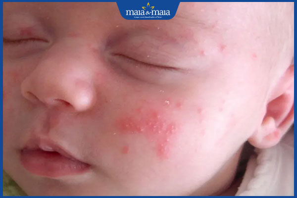 Mụn trứng cá ở trẻ sơ sinh có bình thường không? Cách xử lý an toàn cho bé 2 trẻ nổi mụn trứng cá