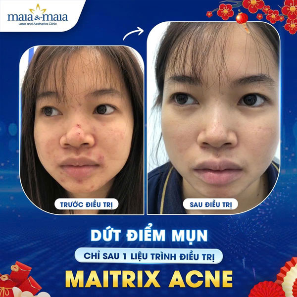 trị mụn thành công tại maia