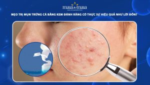 trị mụn trứng cá bằng kem đánh răng