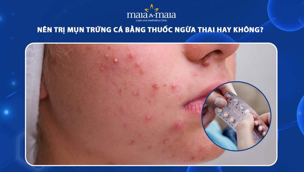 Nên trị mụn trứng cá bằng thuốc ngừa thai hay không? 1 trị mụn trứng cá bằng thuốc ngừa thai
