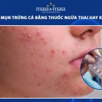 trị mụn trứng cá bằng thuốc ngừa thai