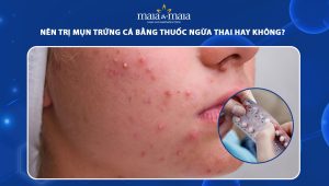 trị mụn trứng cá bằng thuốc ngừa thai