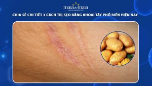 trị sẹo bằng khoai tây