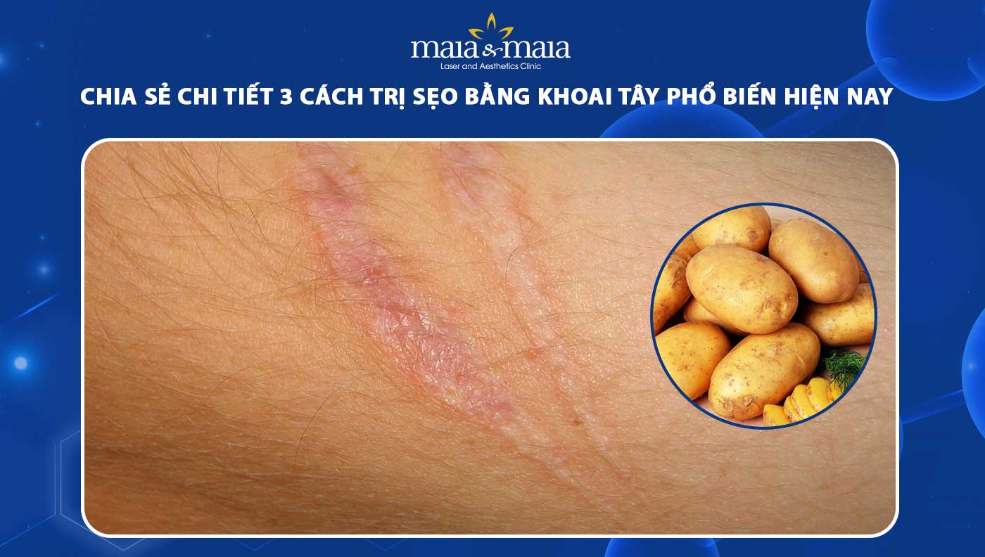 trị sẹo bằng khoai tây