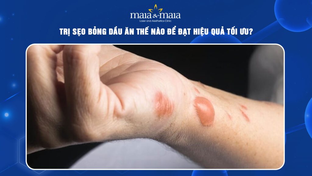 trị sẹo bỏng dầu ăn