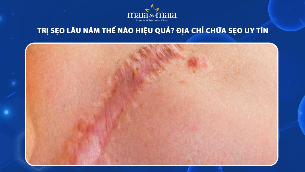 trị sẹo lâu năm