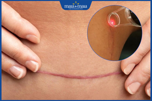 trị sẹo sau sinh bằng laser