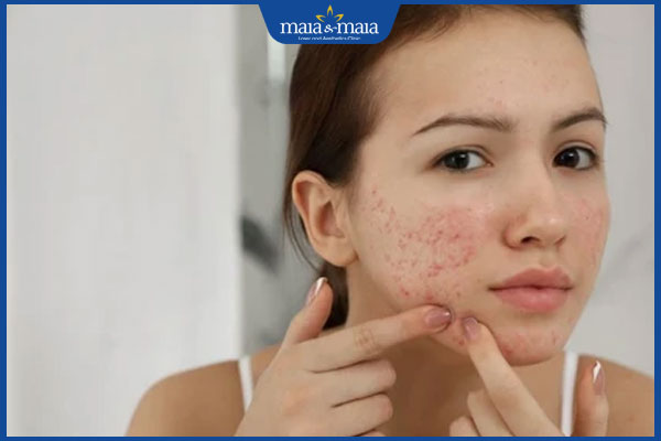 Phương pháp ngăn ngừa mụn trứng cá hiệu quả cải thiện da mịn màng 4 tự ý nặn mụn