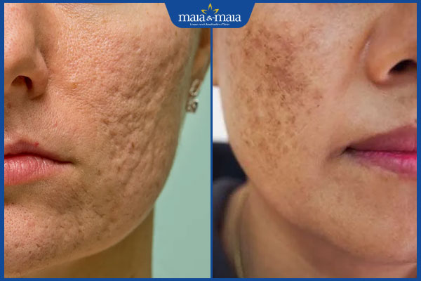 Công nghệ Laser Mixel có tác dụng gì? Quy trình và chi phí thực hiện 2 ứng dụng laser mixel