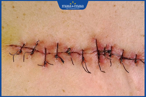 Sẹo phẫu thuật có đặc điểm gì điển hình? Lý do xuất hiện sẹo xấu 3 vết khâu lớn