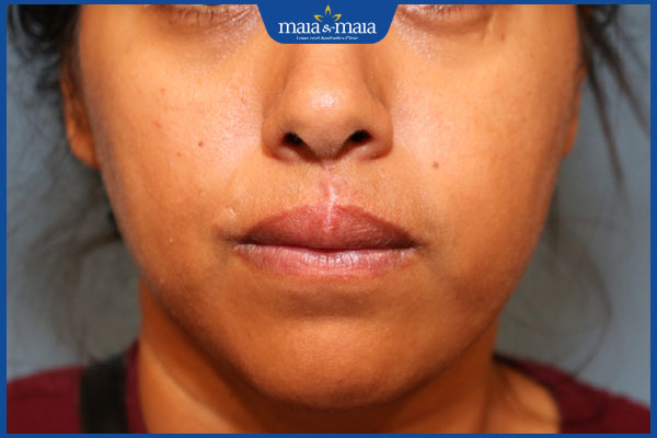 vết sẹo ở nhân trung