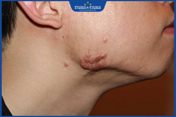 Sẹo ở quai hàm có đặc điểm gì? Gợi ý cách điều trị hiệu quả 2 vết sẹo quai hàm