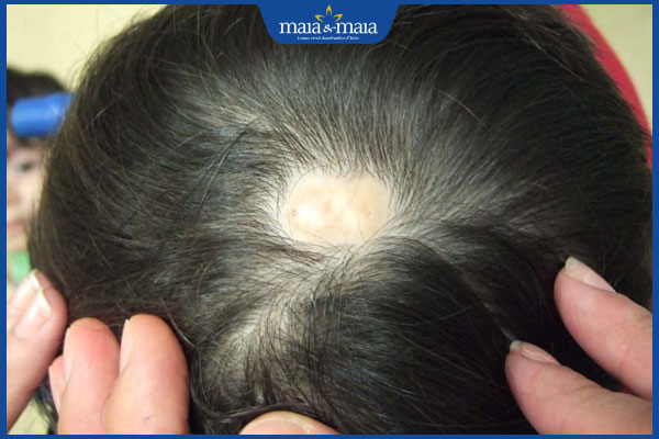 vết sẹo trên da đầu