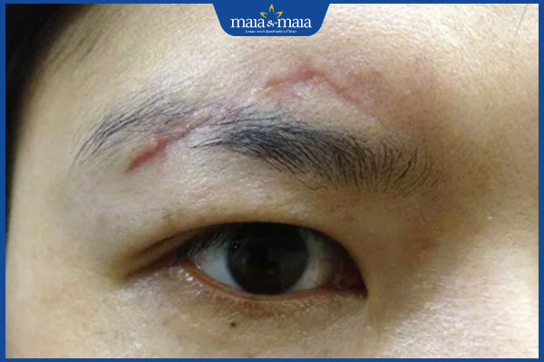 Sẹo ở lông mày nói lên điều gì? Góc nhìn nhân tướng học & thẩm mỹ 2 vết sẹo trên lông mày