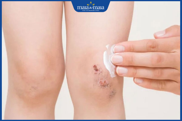 vết thương đã khô