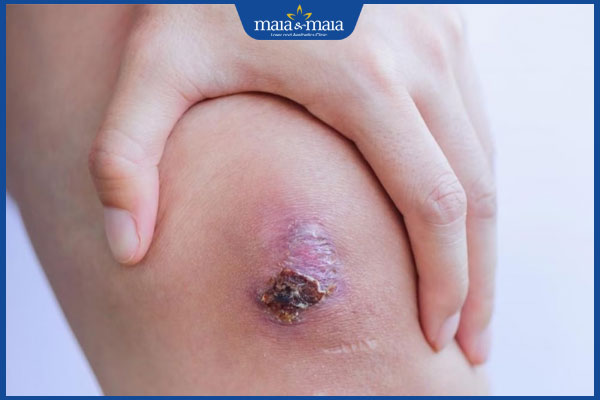 vết thương đang lên da non