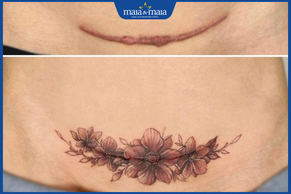 Sẹo lồi có xăm được không? Giải đáp chi tiết theo y khoa 2 xăm sẹo nghệ thuật