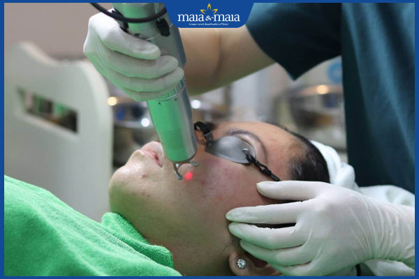 bắn laser trị mụn