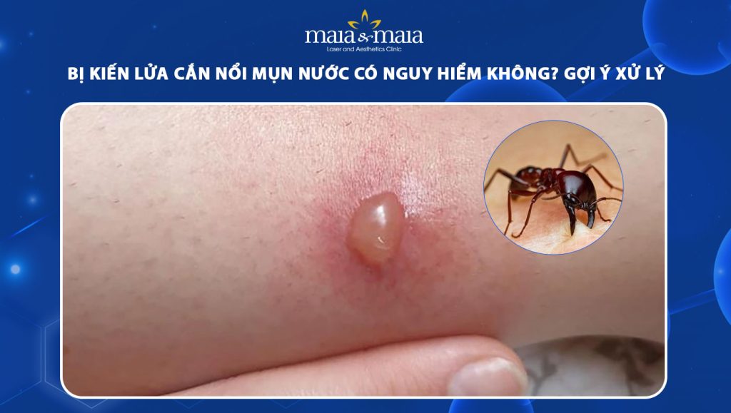 Bị kiến lửa cắn nổi mụn nước có nguy hiểm không? Cách xử lý 1 bị kiến lửa cắn nổi mụn nước