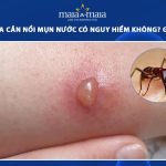 bị kiến lửa cắn nổi mụn nước