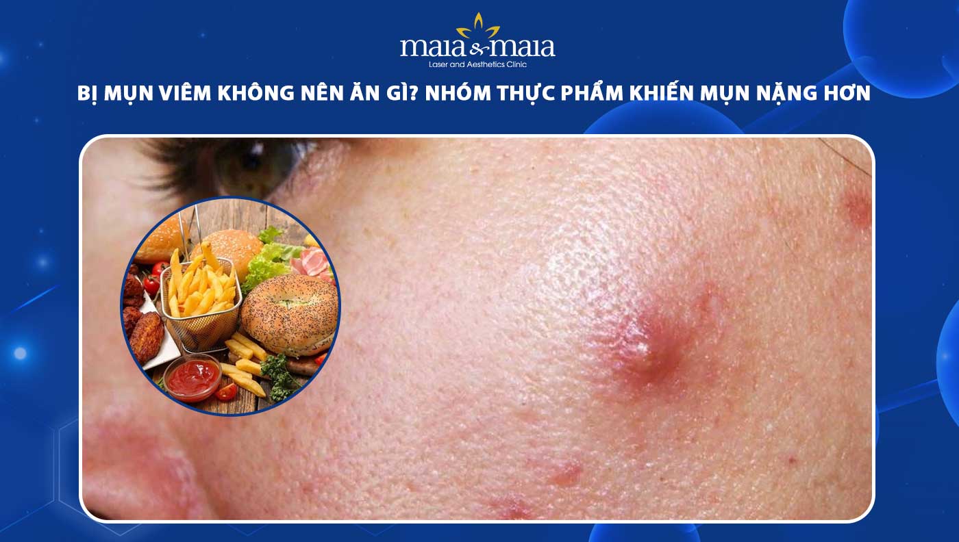 bị mụn viêm không nên ăn gì