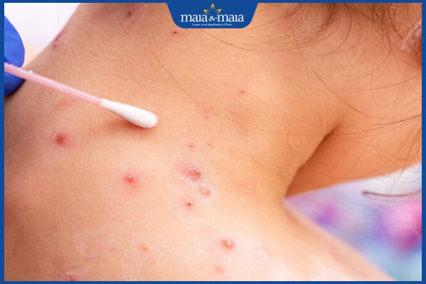 Mụn mủ do đâu? Cách điều trị hiệu quả, hạn chế thâm sẹo trên da 3 bôi thuốc cho mụn mủ