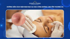 cách nặn mụn bọc bị chai cứng