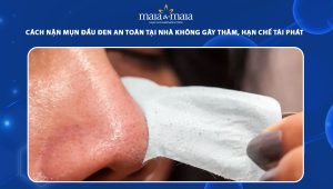 cách nặn mụn đầu đen