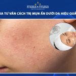 cách trị mụn ẩn dưới da