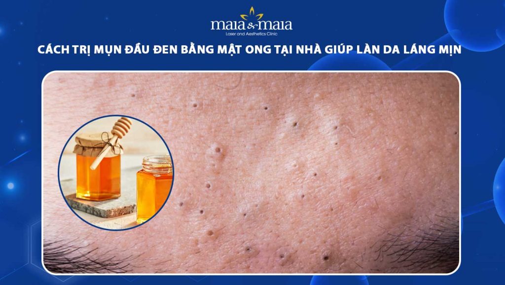 cách trị mụn đầu đen bằng mật ong