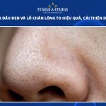 cách trị mụn đầu đen và lỗ chân lông to