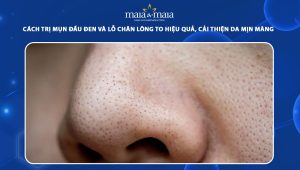 cách trị mụn đầu đen và lỗ chân lông to