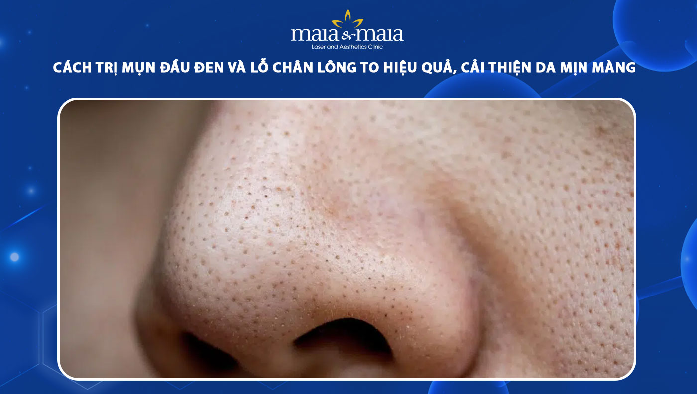 cách trị mụn đầu đen và lỗ chân lông to