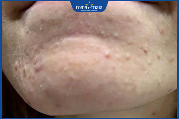 cằm nổi mụn ẩn