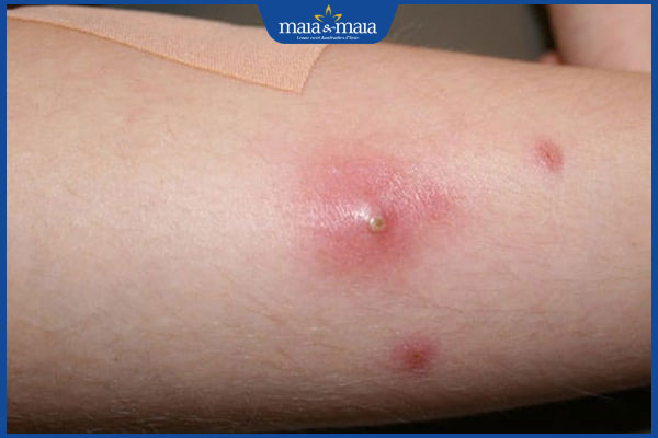 Mụn mủ ở chân điều trị thế nào? Cách phòng tránh tái phát 2 chân nổi mụn mủ