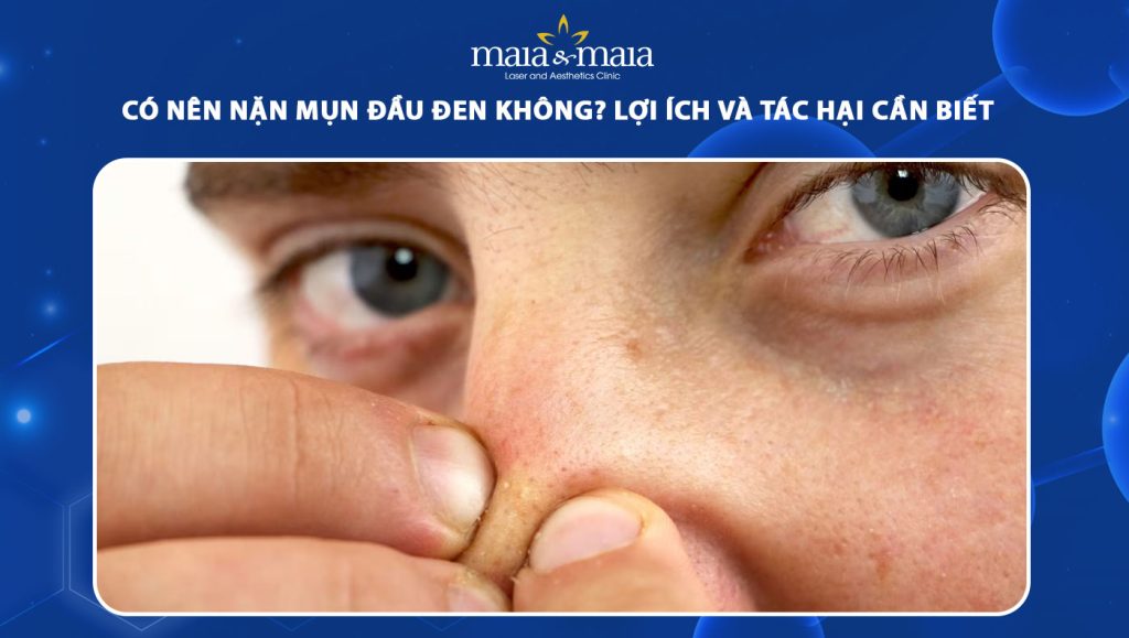 có nên nặn mụn đầu đen không