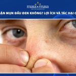 có nên nặn mụn đầu đen không