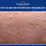 da mặt sần sùi nhiều mụn cám