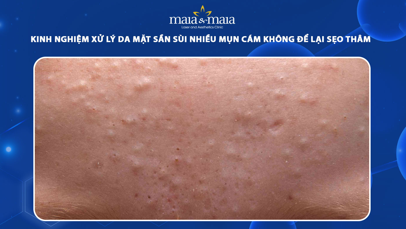 da mặt sần sùi nhiều mụn cám