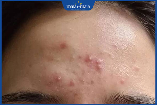 đặc điểm mụn bọc trán