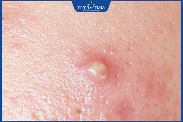 Mụn bọc là gì? Nguyên nhân và cách điều trị mụn bọc hiệu quả 2 đặc điểm mụn bọc