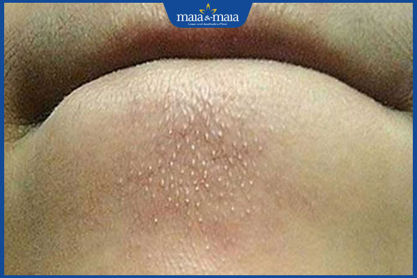 Mụn cám quanh miệng có đặc điểm gì? Cách điều trị hiệu quả 2 đặc điểm mụn cám quanh miệng