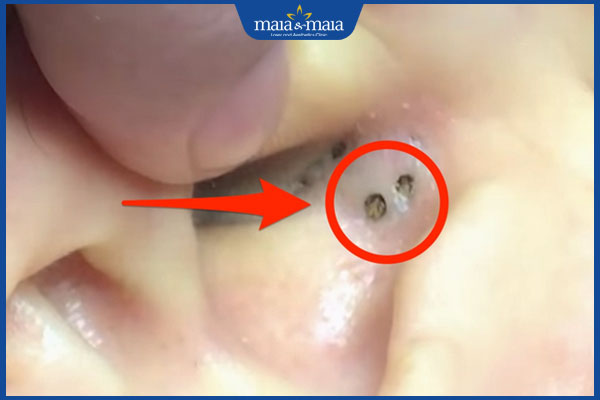Mụn đầu đen trong lỗ tai có dấu hiệu gì? Cách xử lý hiệu quả 2 đặc điểm mụn đầu đen trong lỗ tai