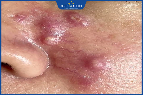 đặc điểm mụn viêm ăn luồng