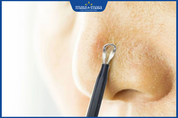 Nặn mụn đầu đen ở mũi thế nào là đúng cách? Hướng dẫn chi tiết 3 dùng que nặn mụn ở mũi