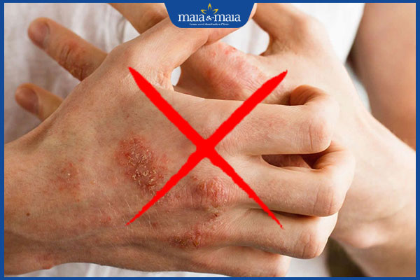 gãi ngứa mụn nước