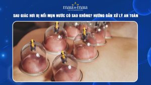 giác hơi bị nổi mụn nước