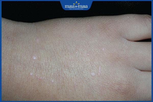 hạt cơm phẳng ở tay