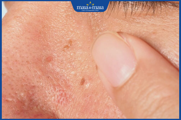 hạt cơm phẳng trên mặt